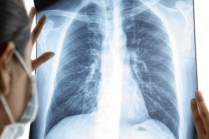 Cara Mengatasi Penyakit Bronkitis Menggunakan Bawang Putih